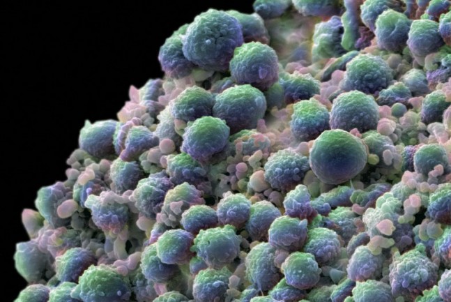 cancerprostata