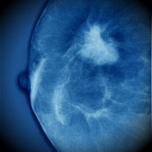 brestcancer