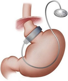 Banda-gastrica-ajustable-en-bypass-gastrico