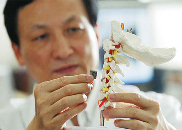 Implantan en China la primera vértebra fabricada con una impresora 3D