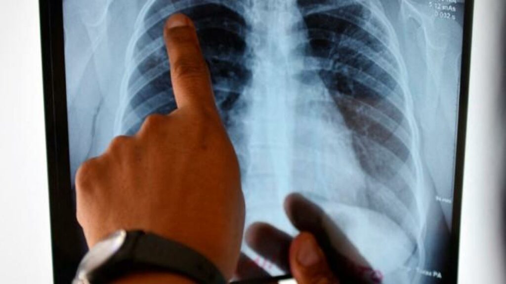tuberculosis