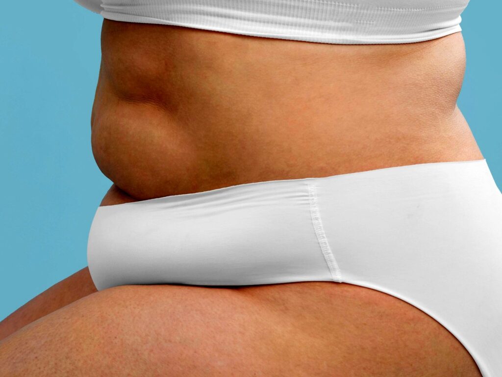 gastroplastia